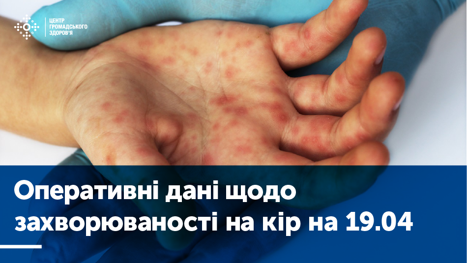 З початку року на кір захворіло майже 42 000 українців