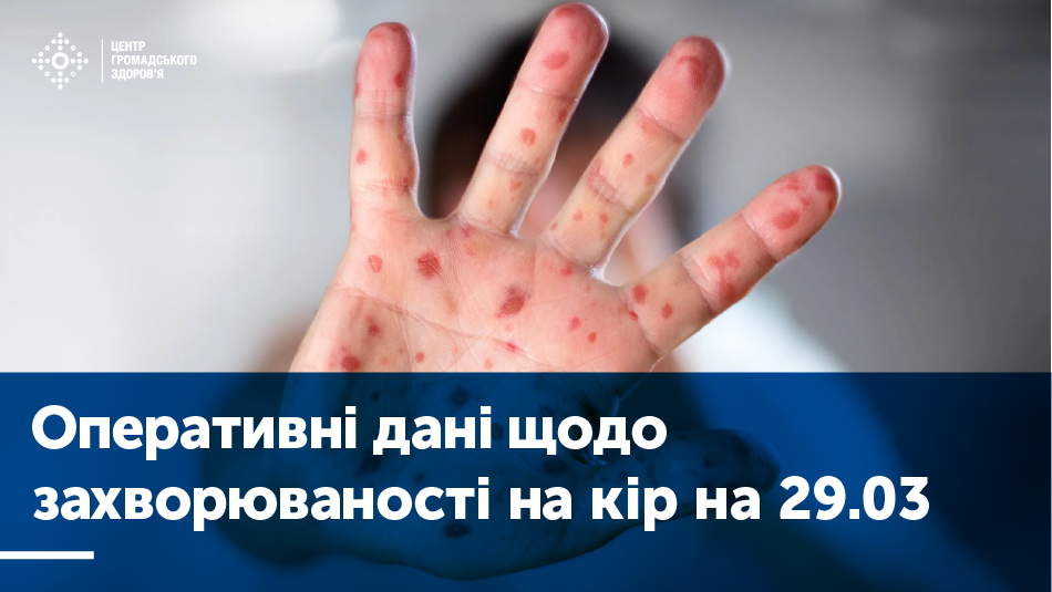 З початку року на кір захворіло 35 000 українців, і рівень захворюваності знову зростає. Єдиний надійний захист — вакцинація