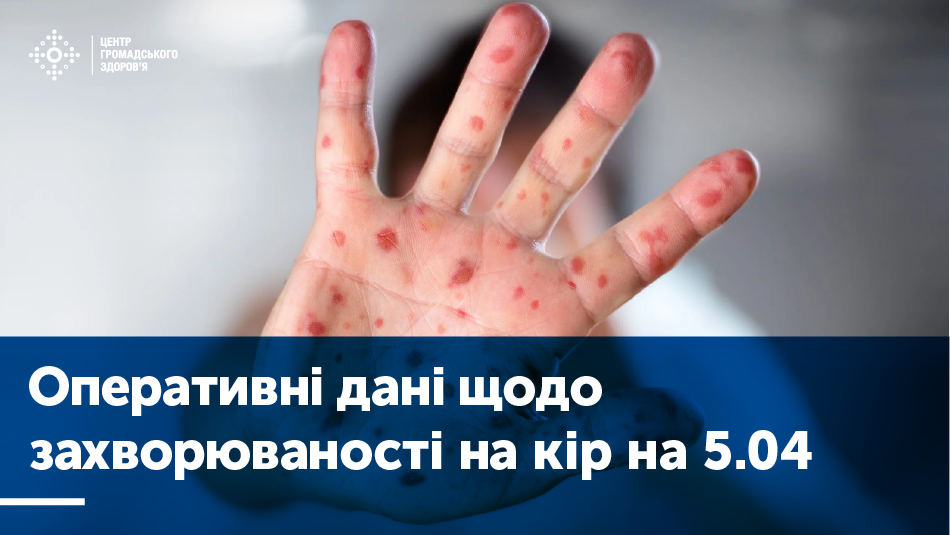 З початку року на кір захворіло більше 37 000 українців, і рівень захворюваності знову зростає