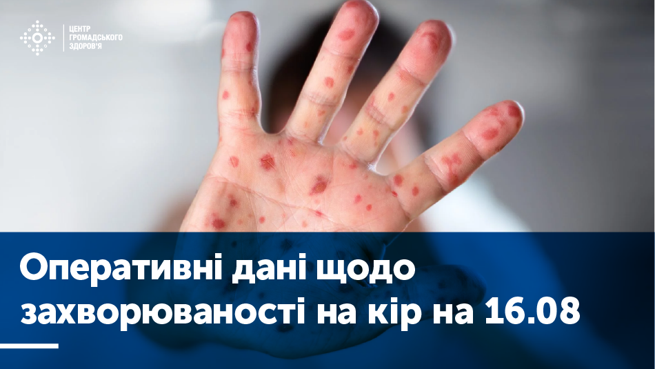 Кір не відступає. МОЗ України закликає вакцинуватися до 1 вересня