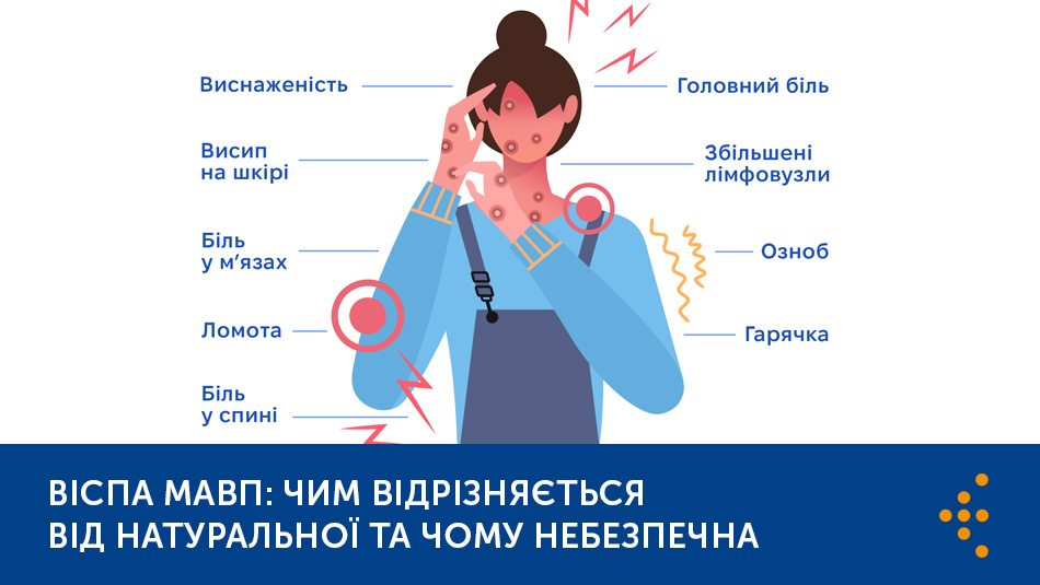 Віспа мавп: чим відрізняється від натуральної та чому небезпечна