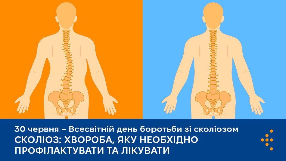 Сколіоз: хвороба, яку необхідно профілактувати та лікувати