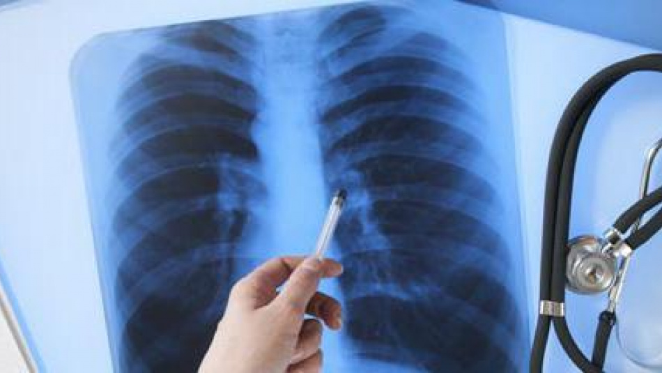 В Україні пройде акція з безкоштовної перевірки на туберкульоз